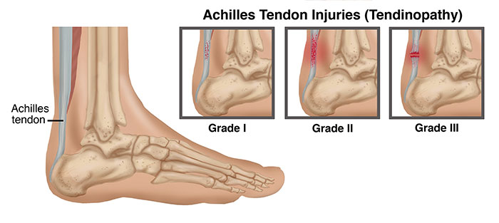 AchilleTendon-Injury-LG