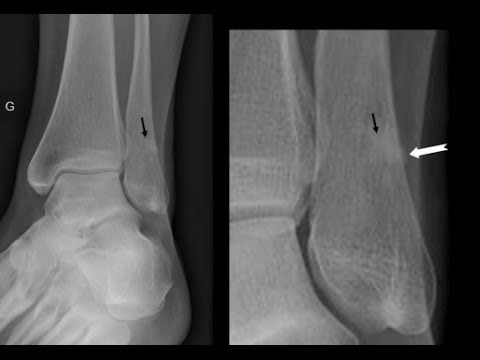 stress-fracture