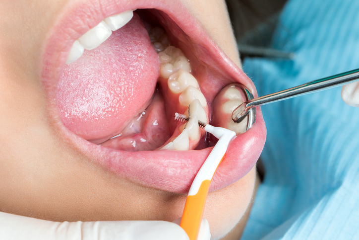Macro close up of interdental cleaning on human teeth.