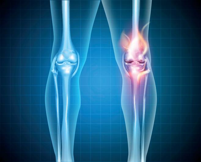 Burning knee, painful knee and normal knee joint, abstract design.