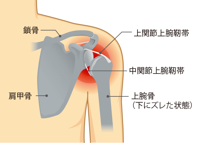 shoulder-dislocation-ai